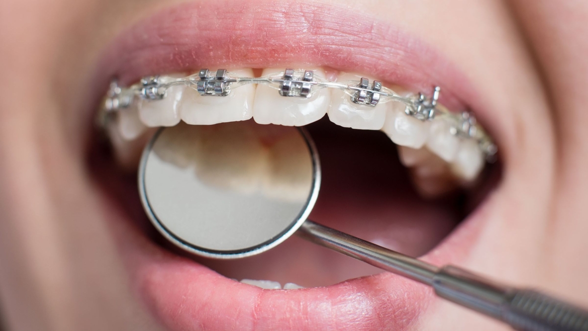 Braces