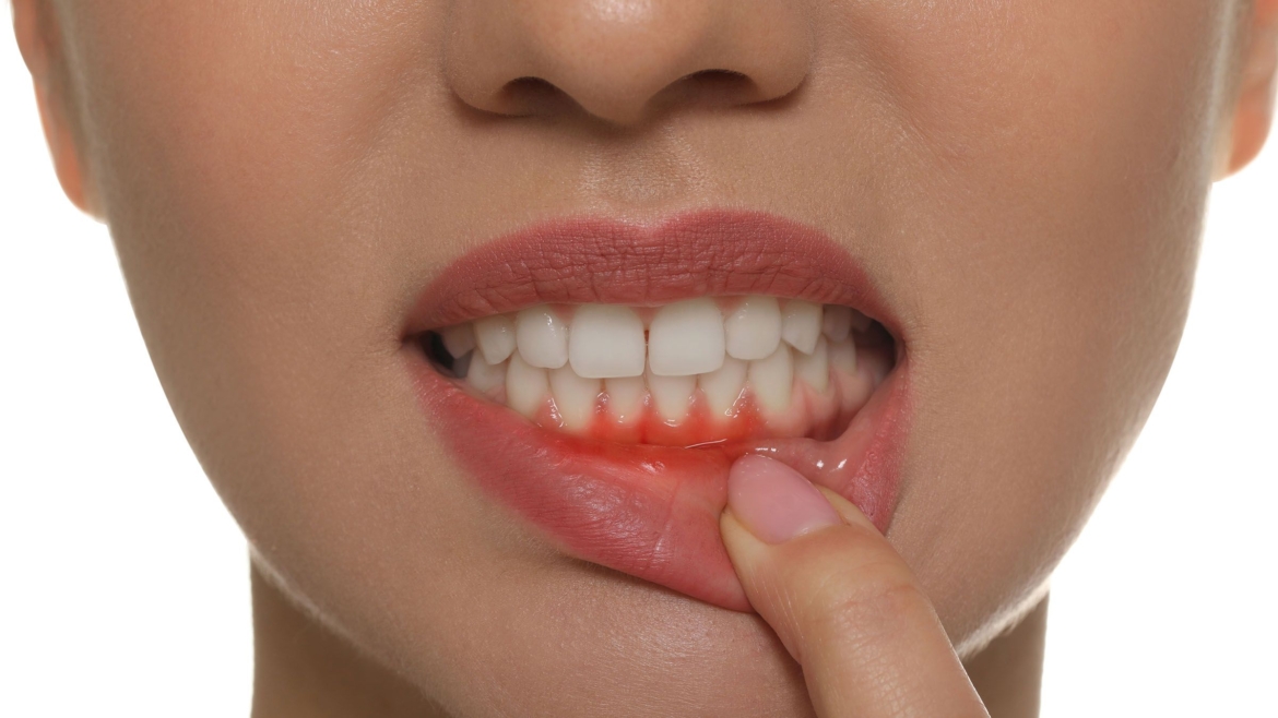 Gum treatment