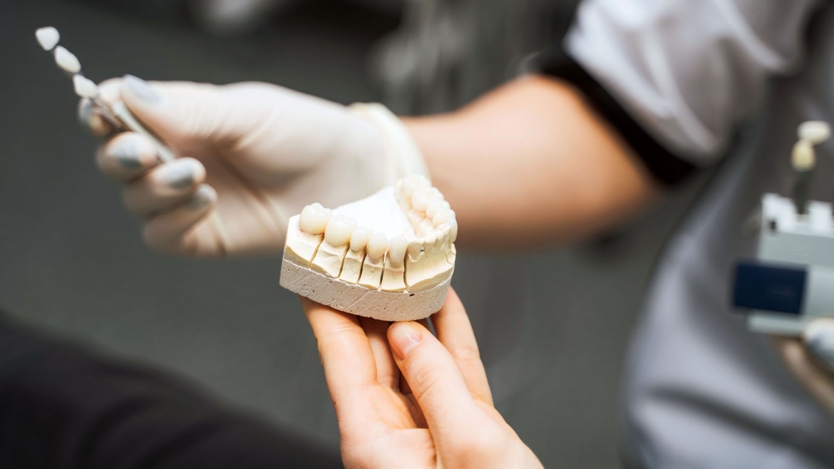 Crowns and veneers